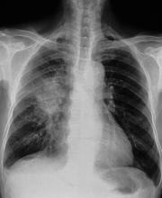 Chest X-ray showing Tuberculosis (Tb)