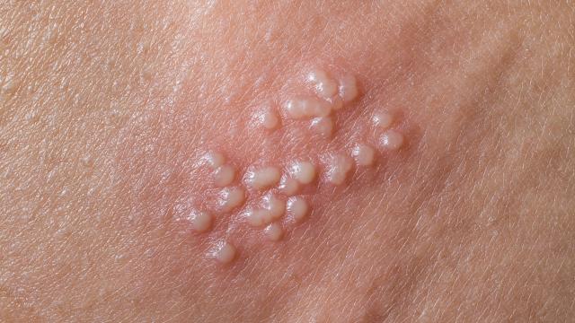 Clusters of white bumps on skin as herpes.