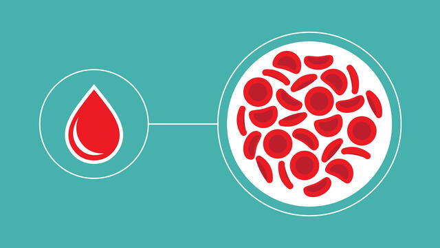 Drawing of a drop of blood with magnification showing sickle cells