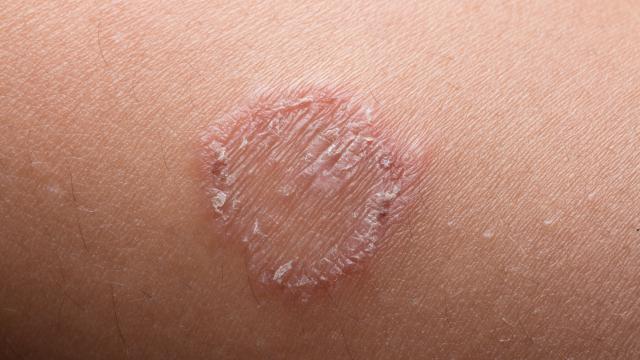 Crusting circle spot on skin or ring worm infection.