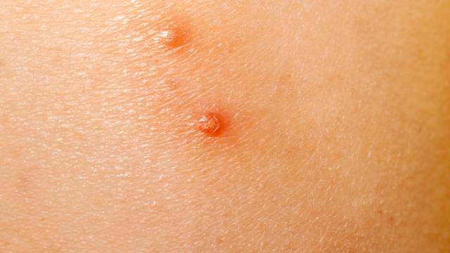 Water warts as red bumps on skin.