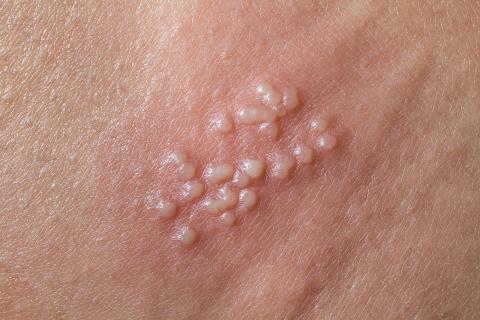Clusters of white bumps on skin as herpes.