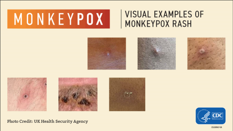 Monkeypox symptom images