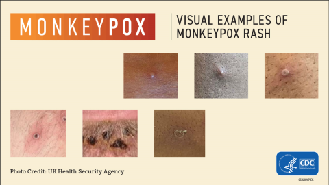 Monkeypox 101: Symptoms, Treatment, and Prevention