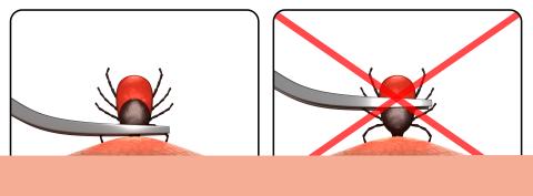 Illustration of a proper way to remove a tick