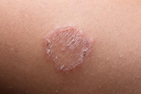 What Causes Rash on Inner Thigh?