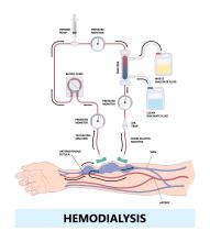 Diagram showing hemodialysis set up