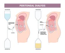 Diagram showing peritoneal dialysis
